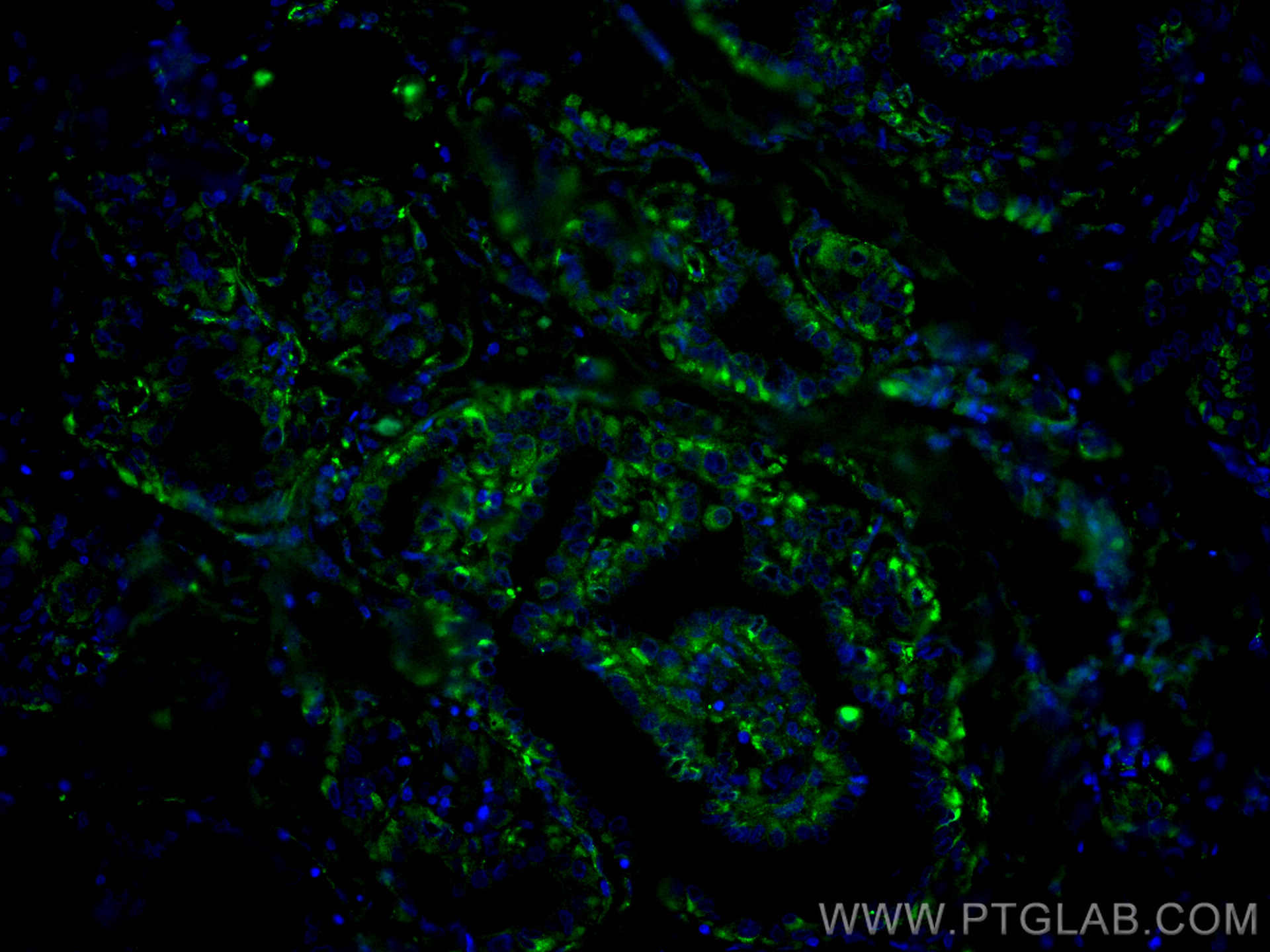IF Staining of human thyroid cancer using CL488-67047