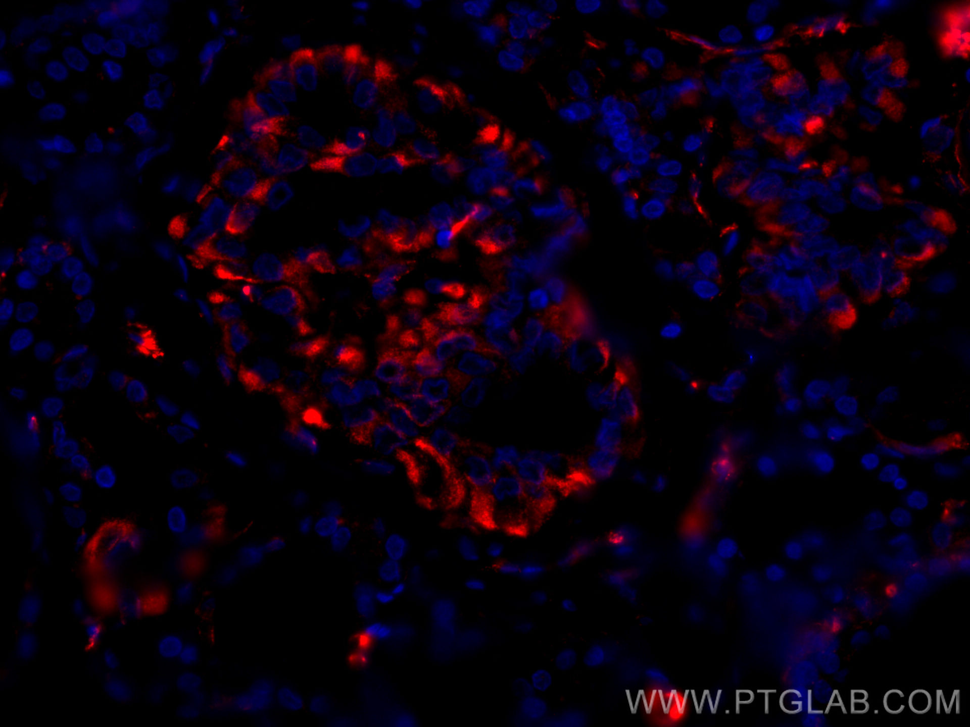IF Staining of human thyroid cancer using CL594-67047