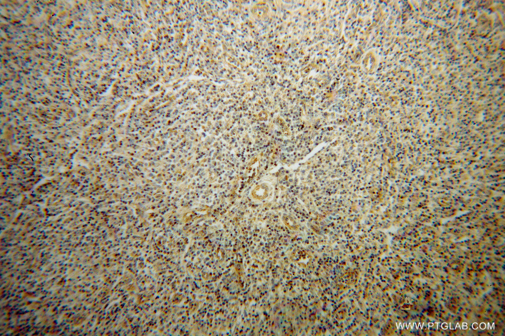 IHC staining of human lymphoma using 11288-1-AP