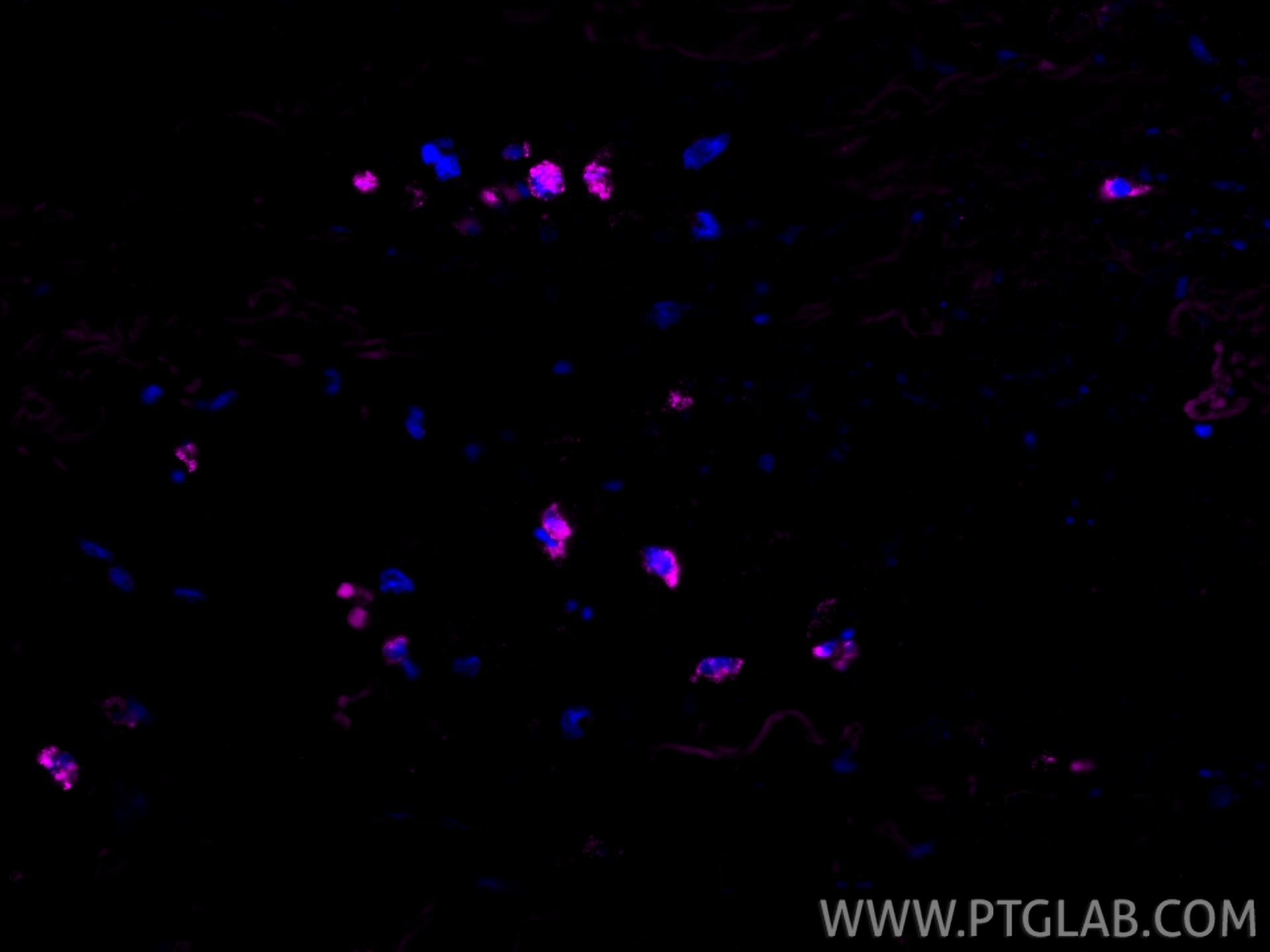 IF Staining of human lung cancer using APC-13588 IF Staining of human lung cancer using APC-13588