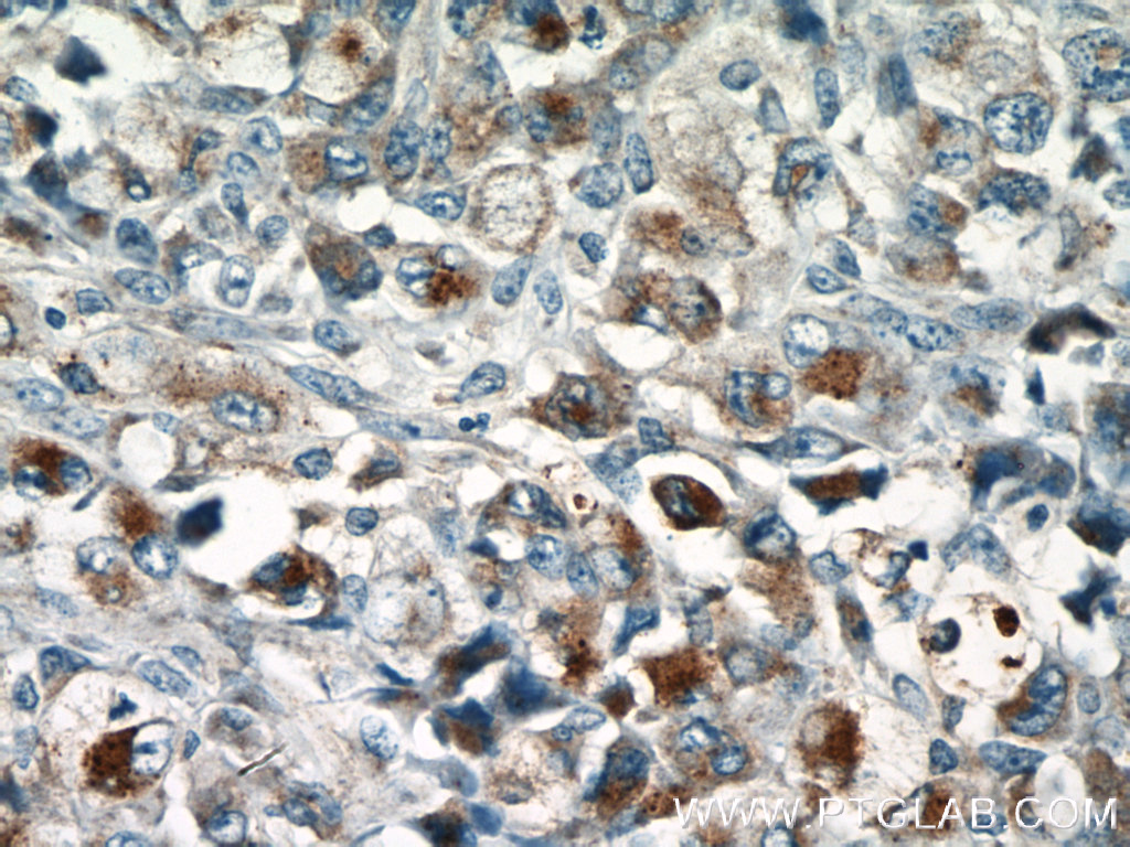 IHC staining of human lymphoma using 13588-1-AP