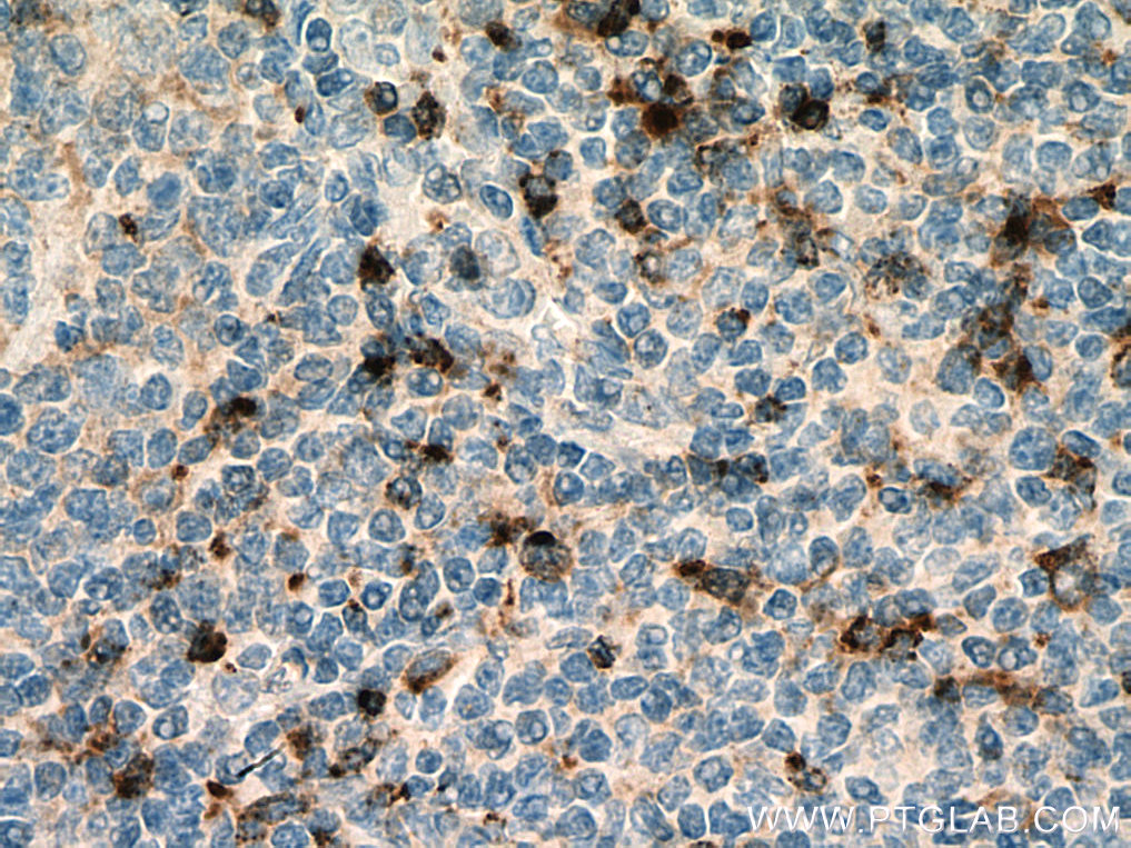 IHC staining of human tonsillitis using 27894-1-AP