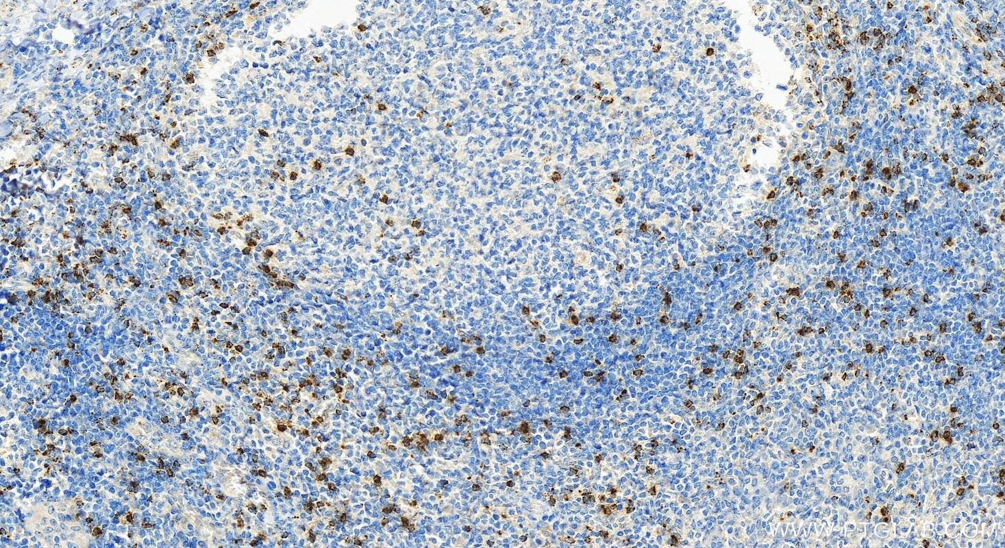 IHC staining of human tonsillitis using 67272-1-Ig
