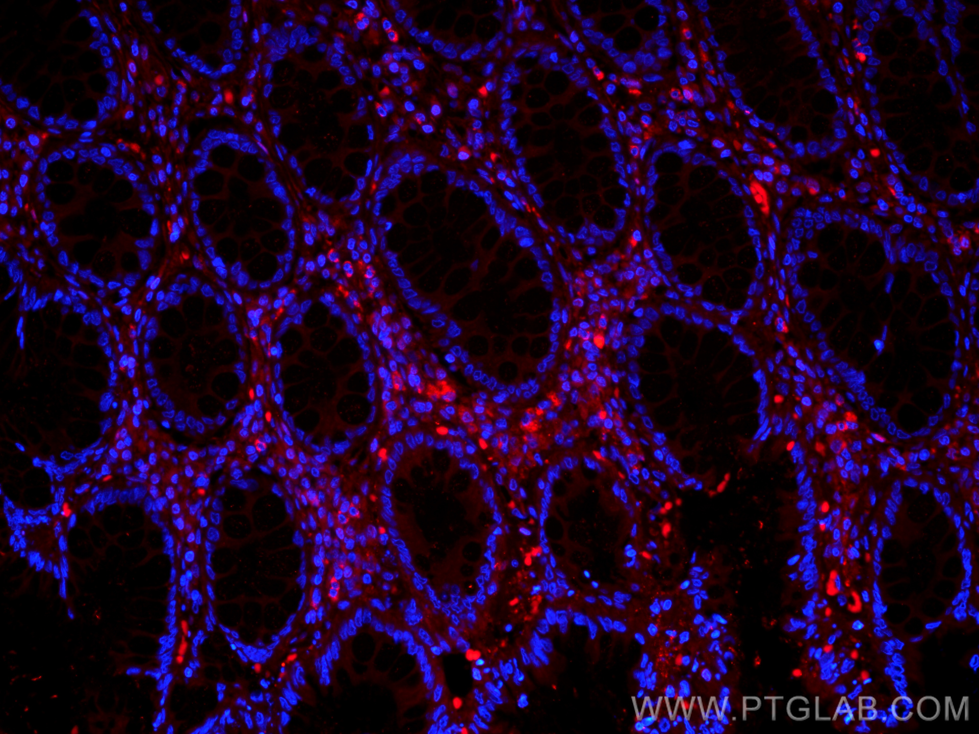 IF Staining of human colon cancer using CL594-60223