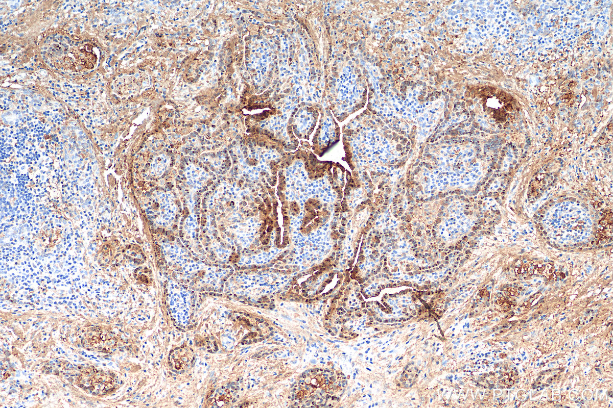 IHC staining of human thyroid cancer using 82024-1-RR