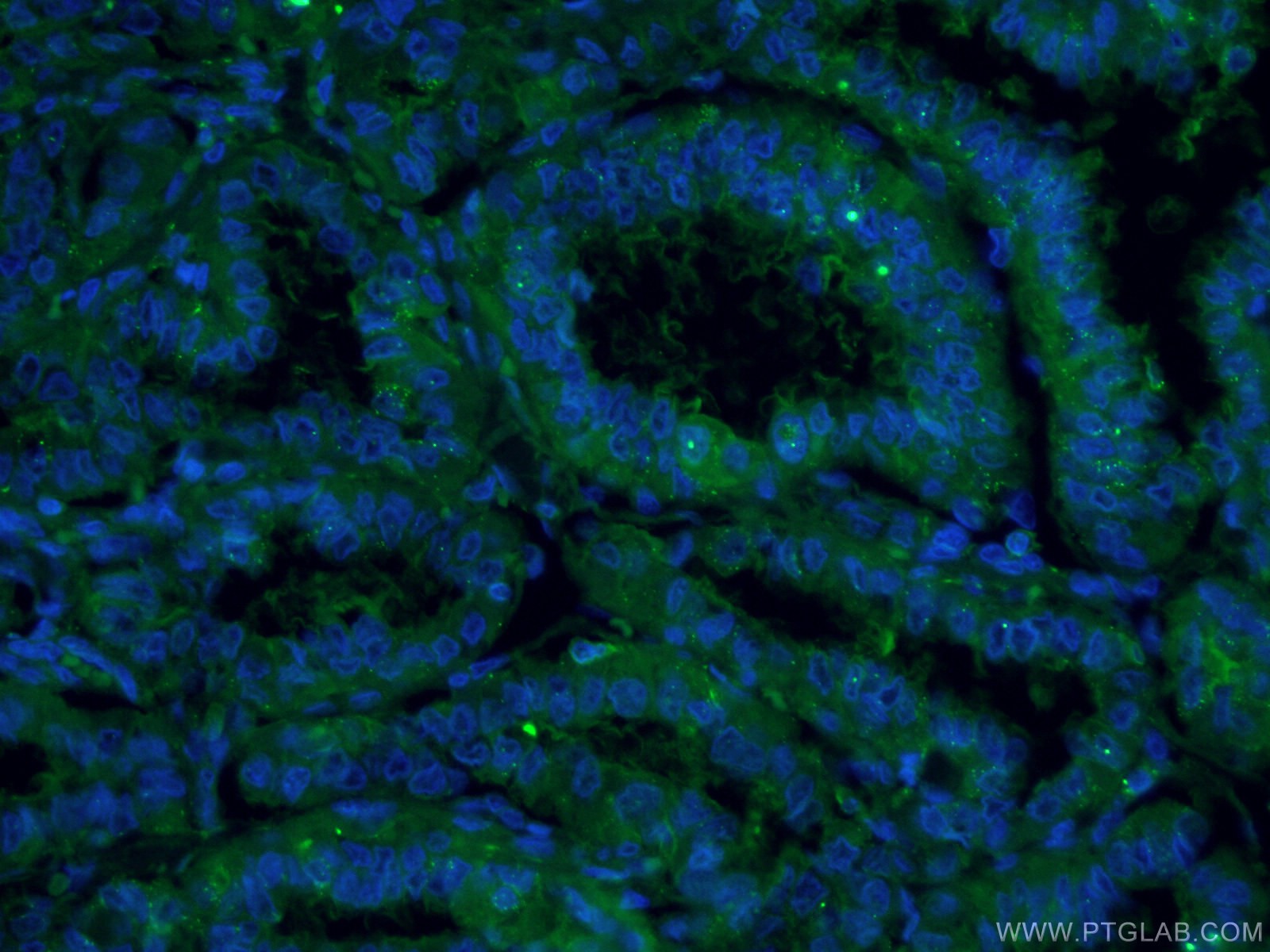 IF Staining of human thyroid cancer using CL488-60207