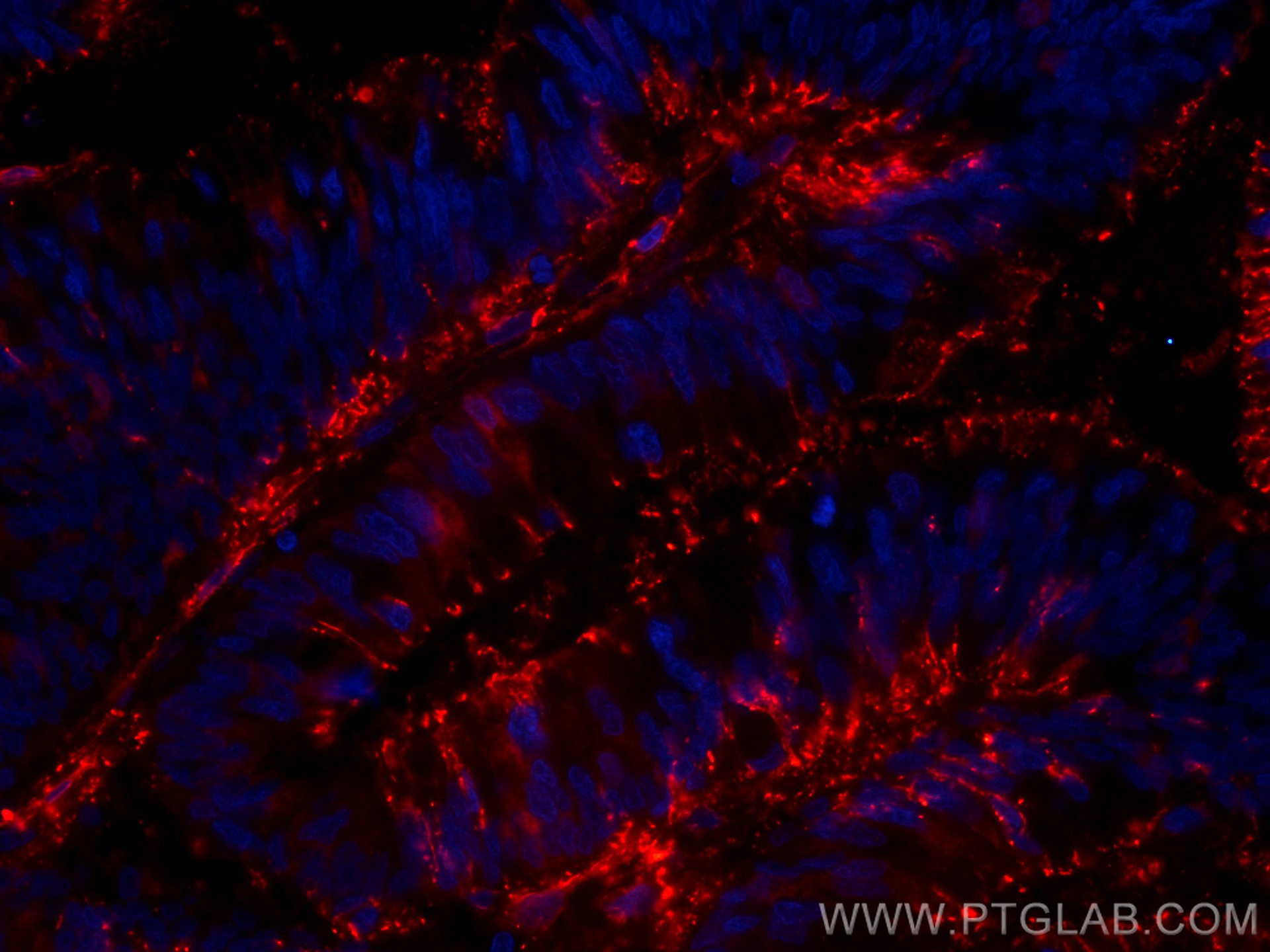 IF Staining of human colon cancer using CL594-66686