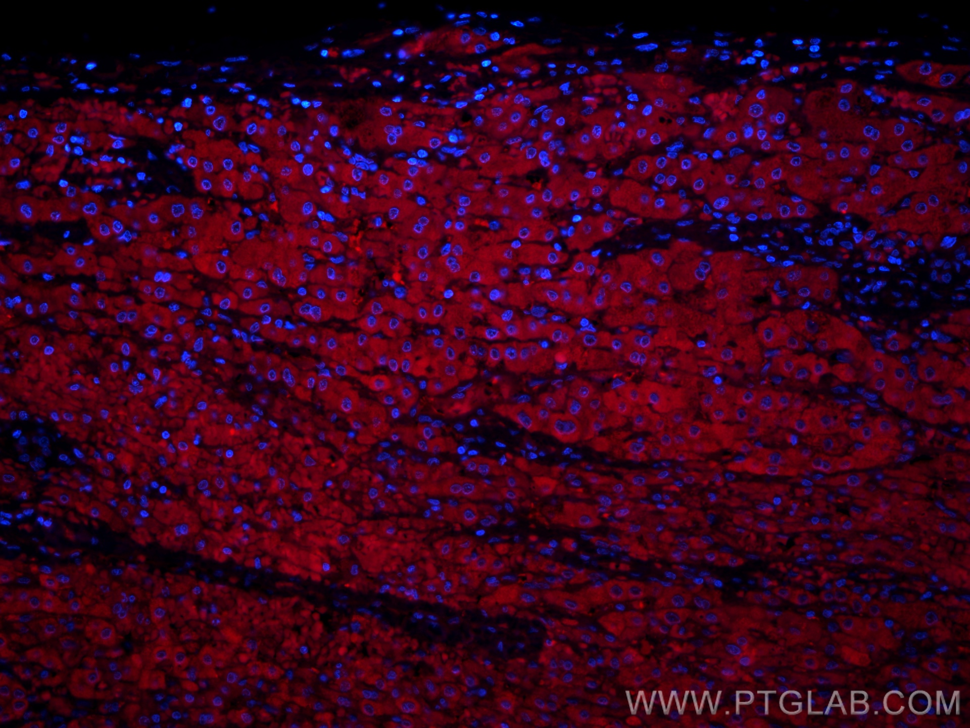 IF Staining of human liver cancer using CL594-12217