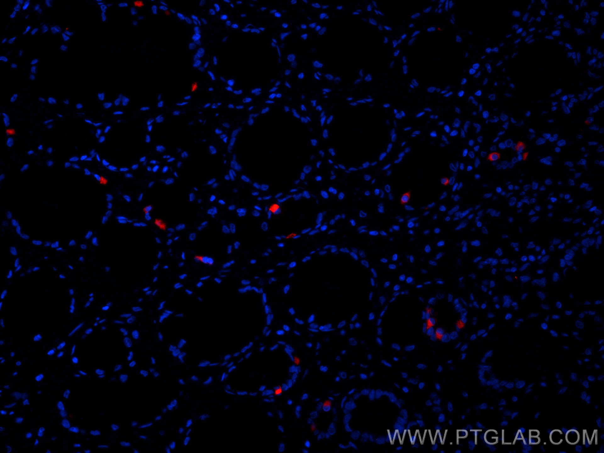 IF Staining of human stomach cancer using CL594-60346