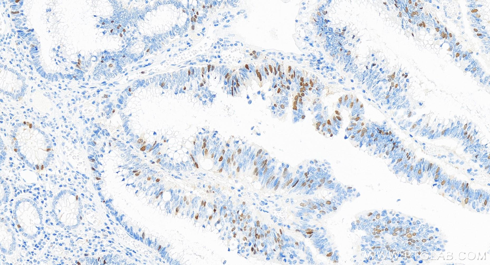 IHC staining of human colon cancer using 84199-2-RR
