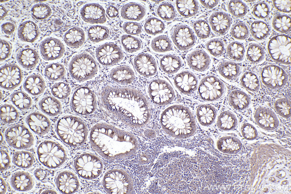IHC staining of human rectal cancer using 22270-1-AP IHC staining of human rectal cancer using 22270-1-AP
