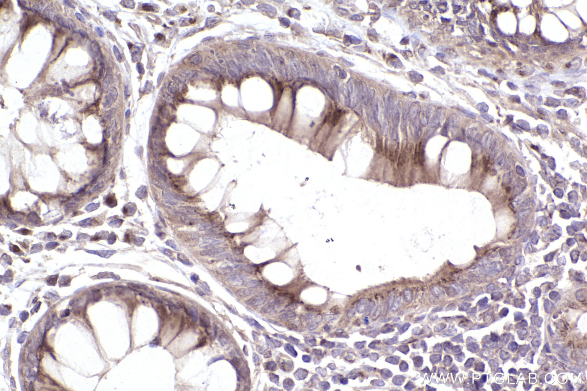 IHC staining of human rectal cancer using 22270-1-AP IHC staining of human rectal cancer using 22270-1-AP