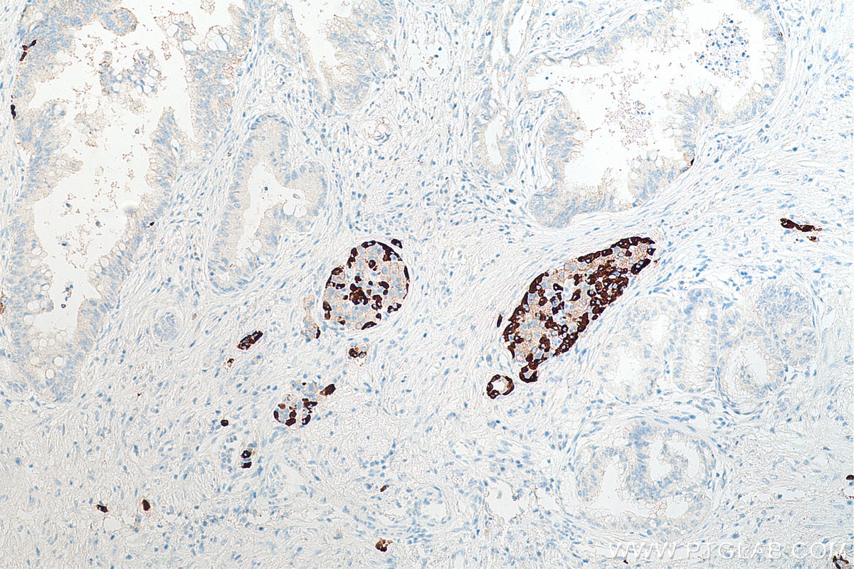 IHC staining of human pancreas cancer using 67286-1-Ig