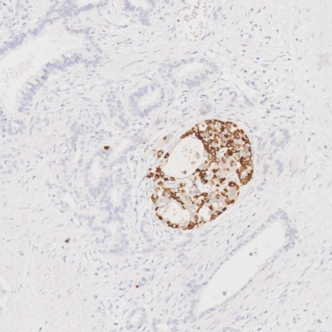 IHC staining of human pancreas cancer using 67286-1-Ig IHC staining of human pancreas cancer using 67286-1-Ig