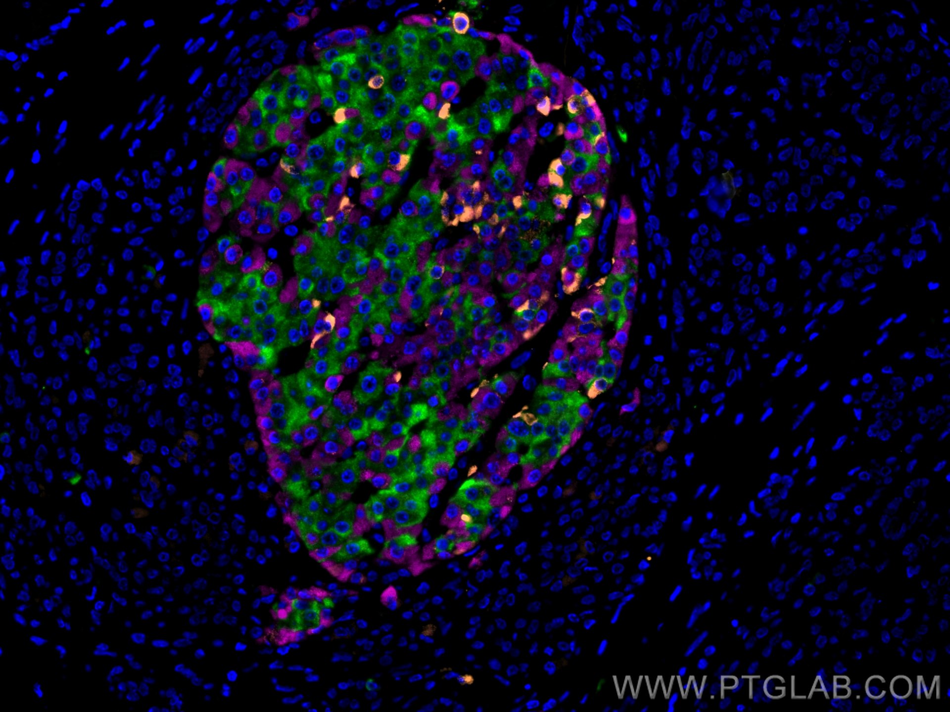 IF Staining of human pancreas cancer using CL647-15954