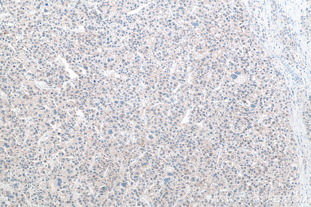IHC staining of human liver cancer using 66323-2-Ig