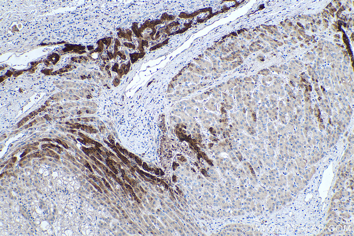 IHC staining of human liver cancer using 66323-2-Ig IHC staining of human liver cancer using 66323-2-Ig