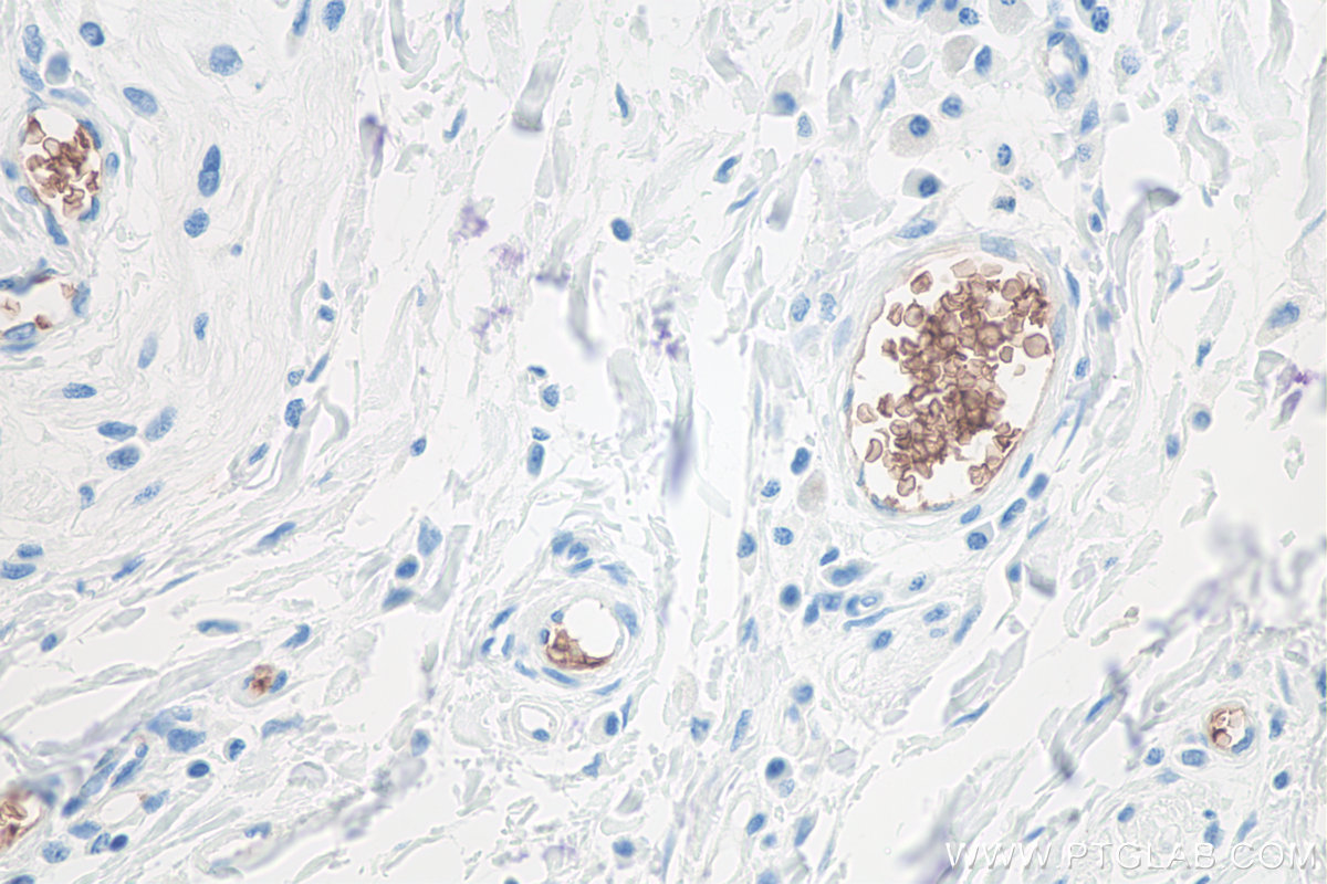IHC staining of human colon cancer using 66778-1-Ig IHC staining of human colon cancer using 66778-1-Ig