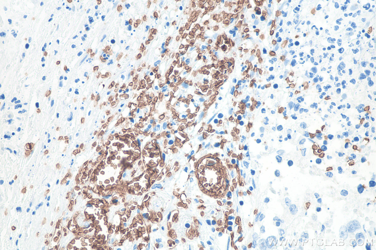 IHC staining of human stomach cancer using 66778-1-Ig IHC staining of human stomach cancer using 66778-1-Ig