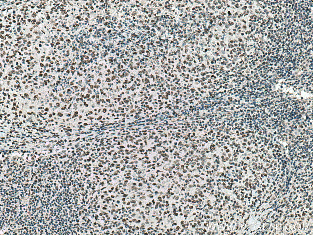 IHC staining of human lymphoma using 10856-1-AP