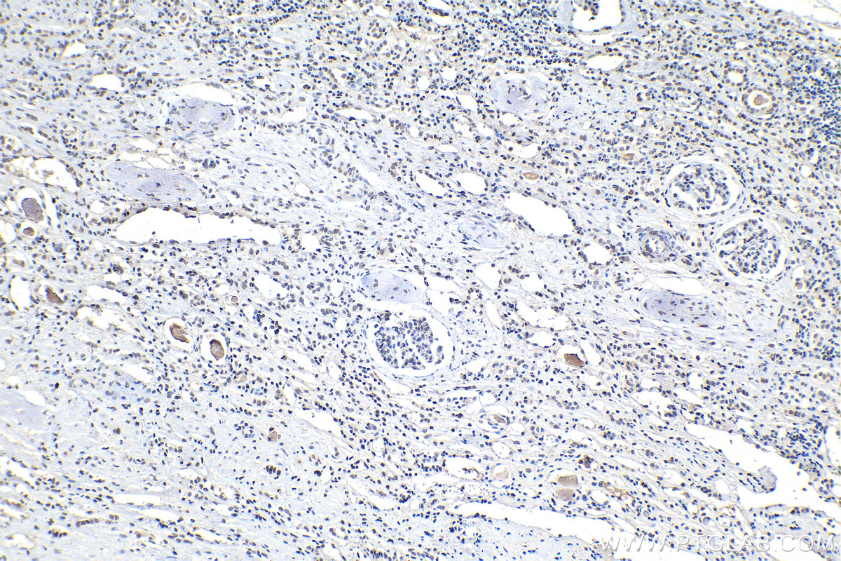 IHC staining of human renal cell carcinoma using 66863-1-Ig (same clone as 66863-1-PBS)