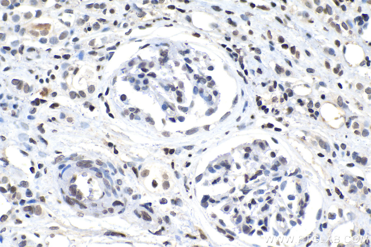 IHC staining of human renal cell carcinoma using 66863-1-Ig