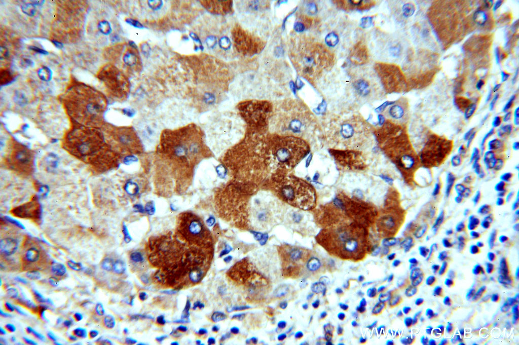 IHC staining of human hepatocirrhosis using 15255-1-AP