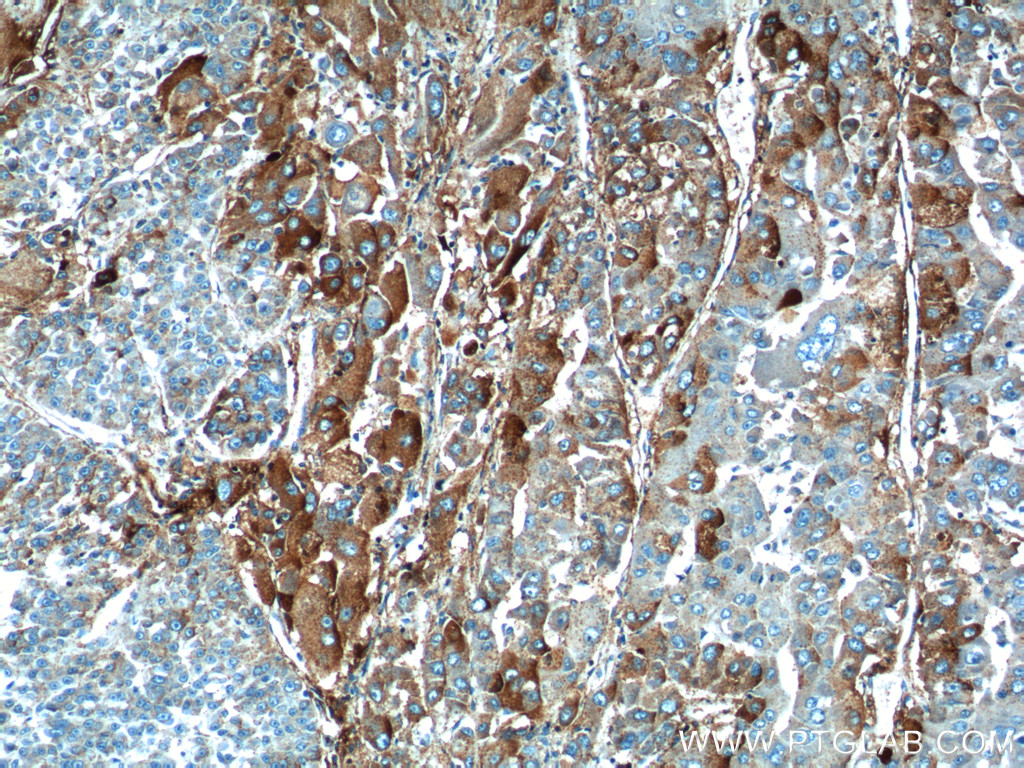 IHC staining of human liver cancer using 12863-1-AP