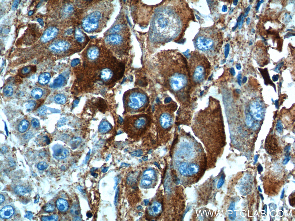 IHC staining of human liver cancer using 12863-1-AP