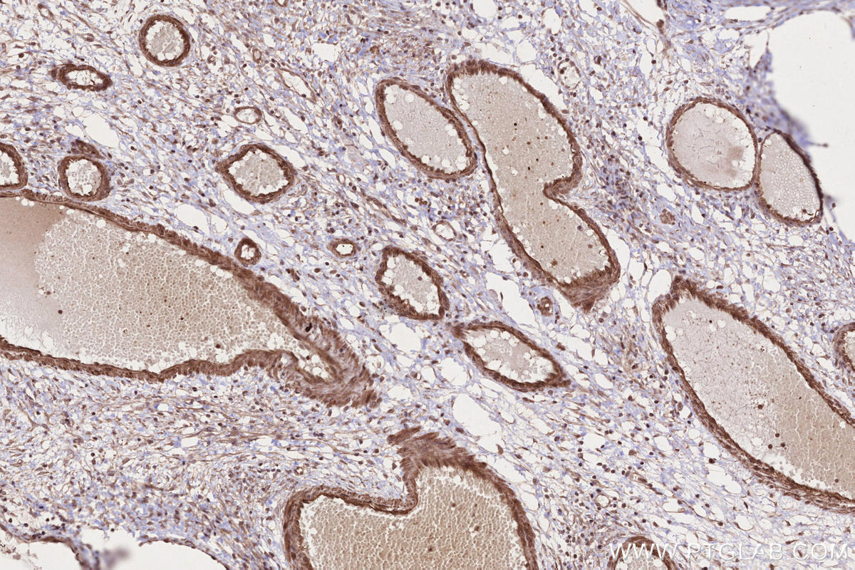 IHC staining of human ovary cancer using 24104-1-AP