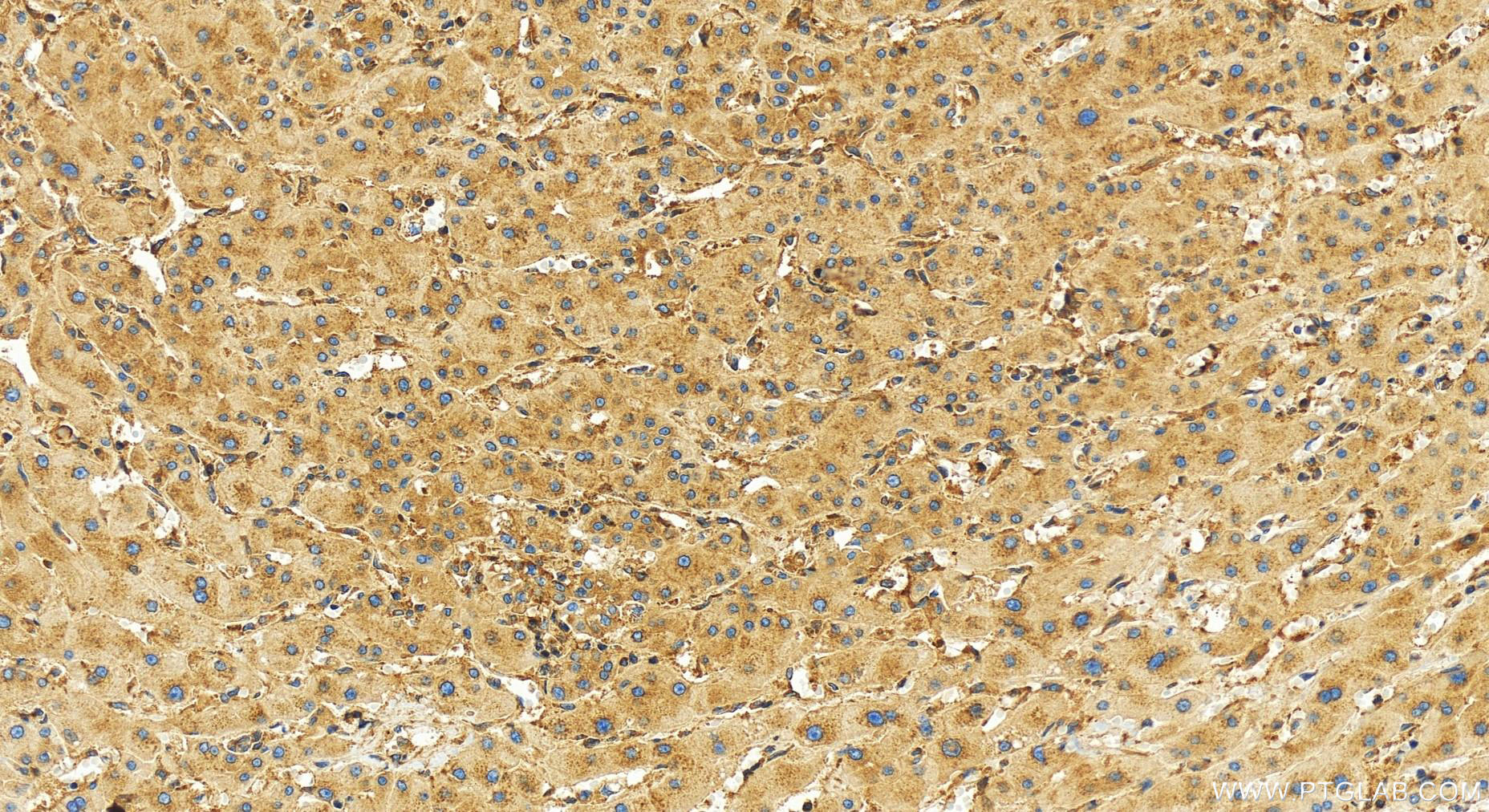 IHC staining of human intrahepatic cholangiocarcinoma using 83497-1-RR (same clone as 83497-1-PBS)
