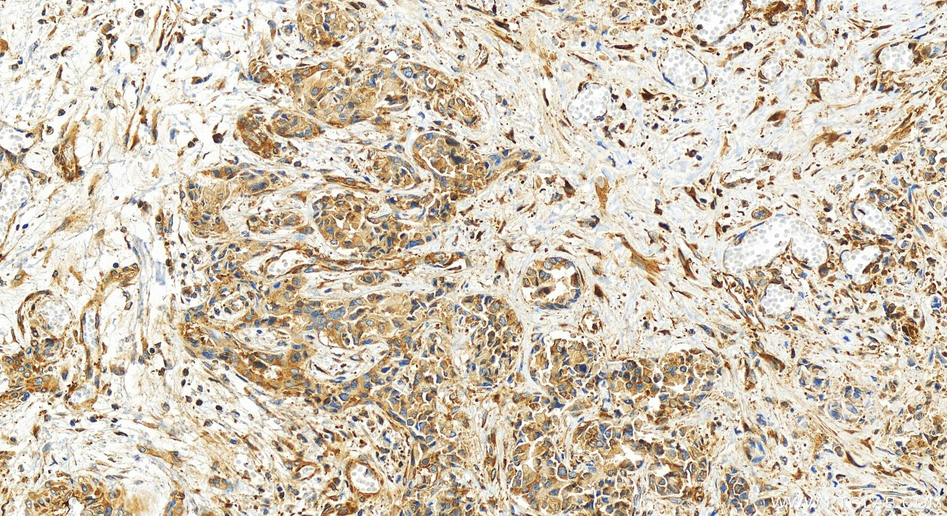 IHC staining of human intrahepatic cholangiocarcinoma using 83497-1-RR (same clone as 83497-1-PBS)