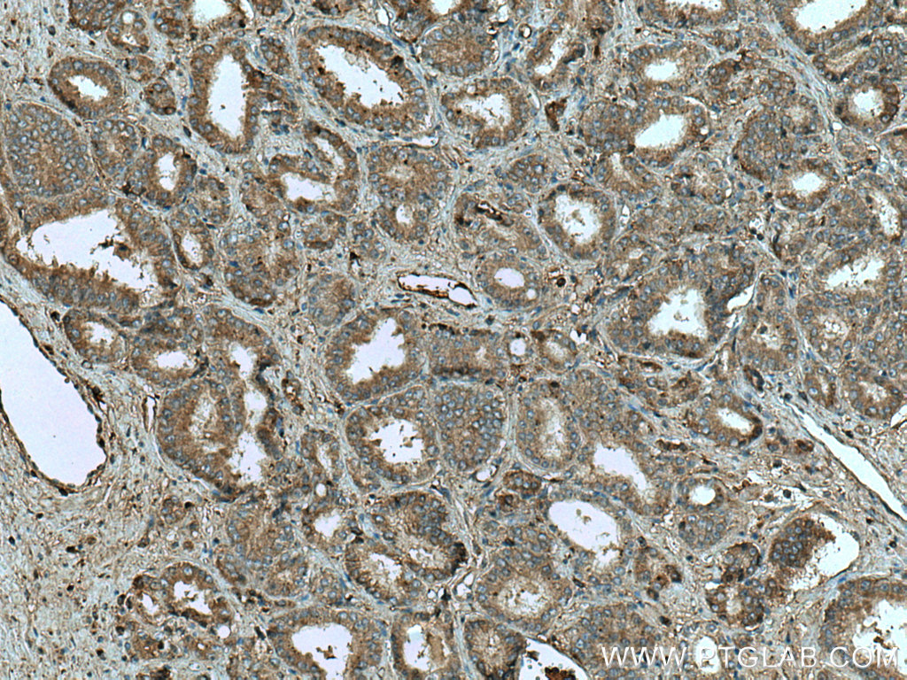 IHC staining of human prostate cancer using 20104-1-AP