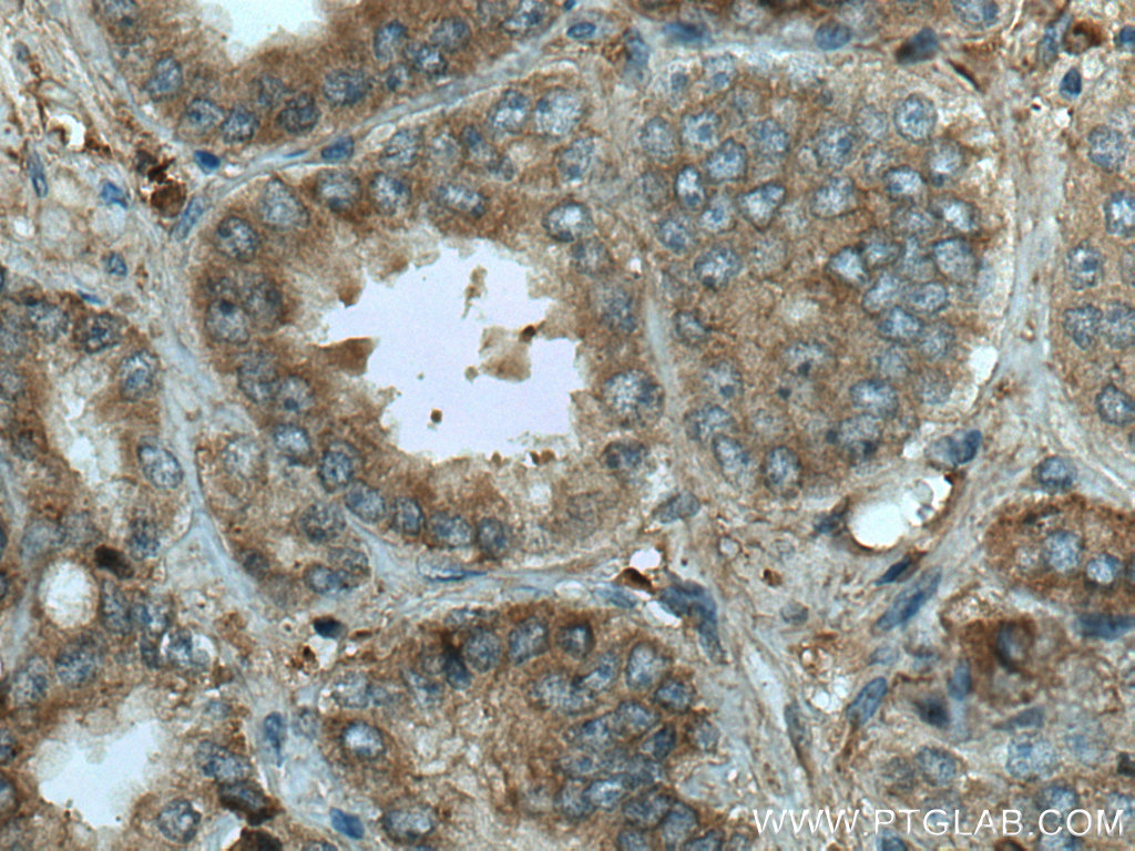 IHC staining of human prostate cancer using 20104-1-AP