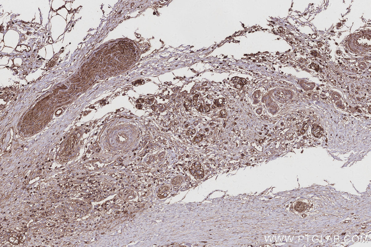 IHC staining of human pancreas cancer using 20104-1-AP IHC staining of human pancreas cancer using 20104-1-AP