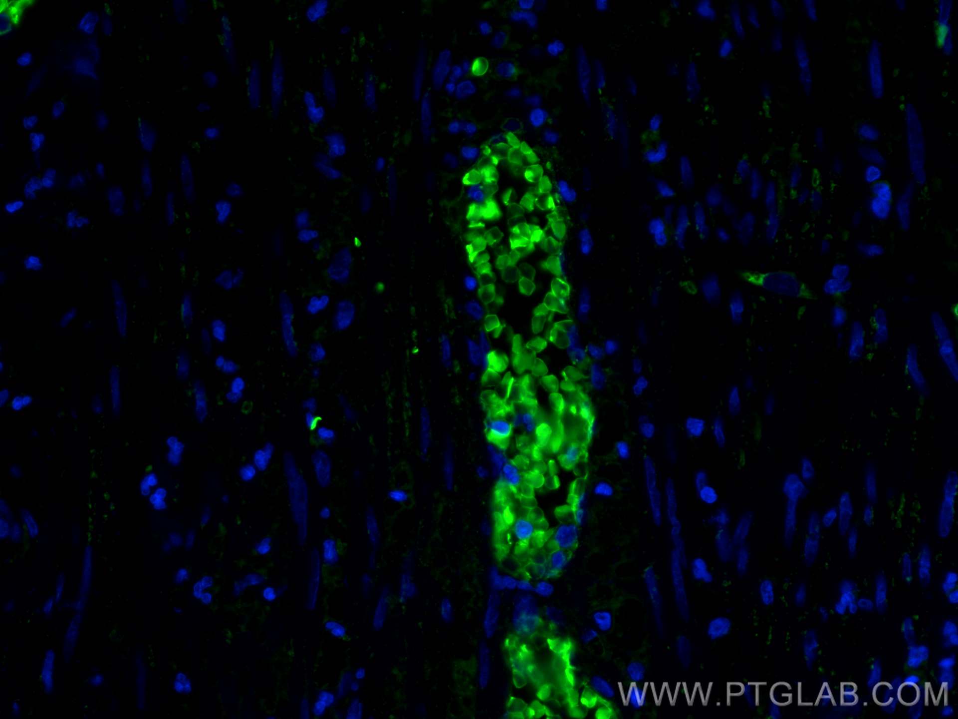 IF Staining of human appendicitis using 16216-1-AP