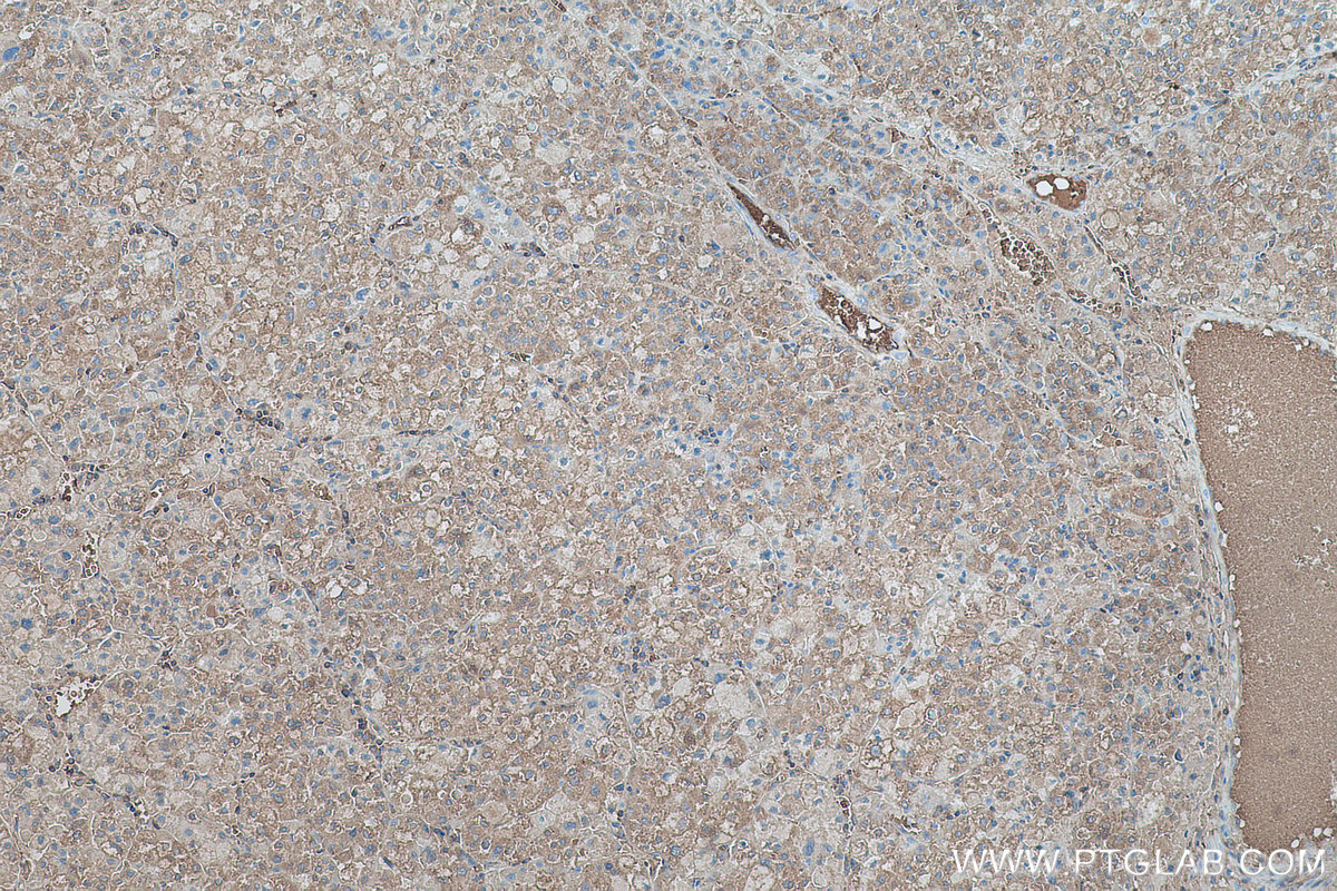 IHC staining of human liver cancer using 67899-1-Ig IHC staining of human liver cancer using 67899-1-Ig