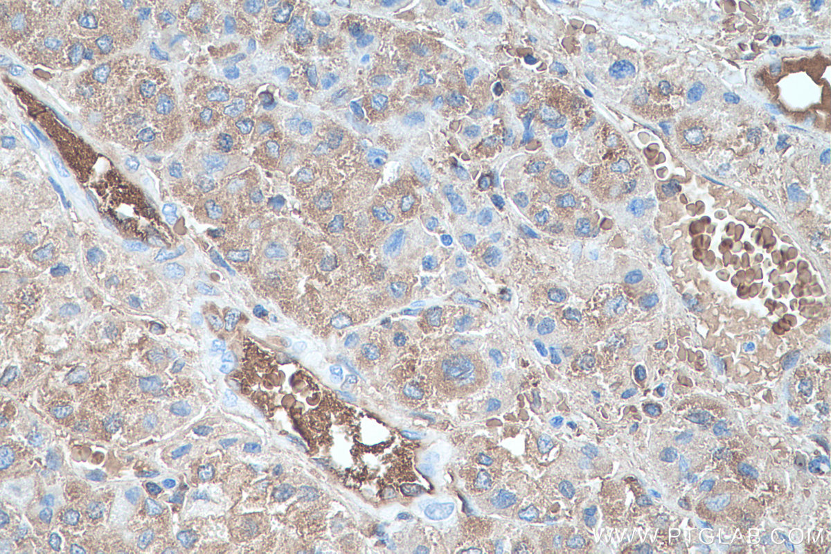 IHC staining of human liver cancer using 67899-1-Ig IHC staining of human liver cancer using 67899-1-Ig