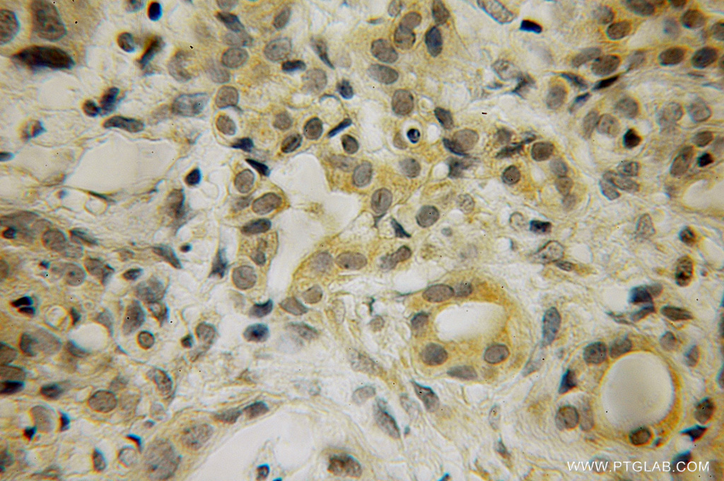 IHC staining of human pancreas cancer using 10359-1-AP
