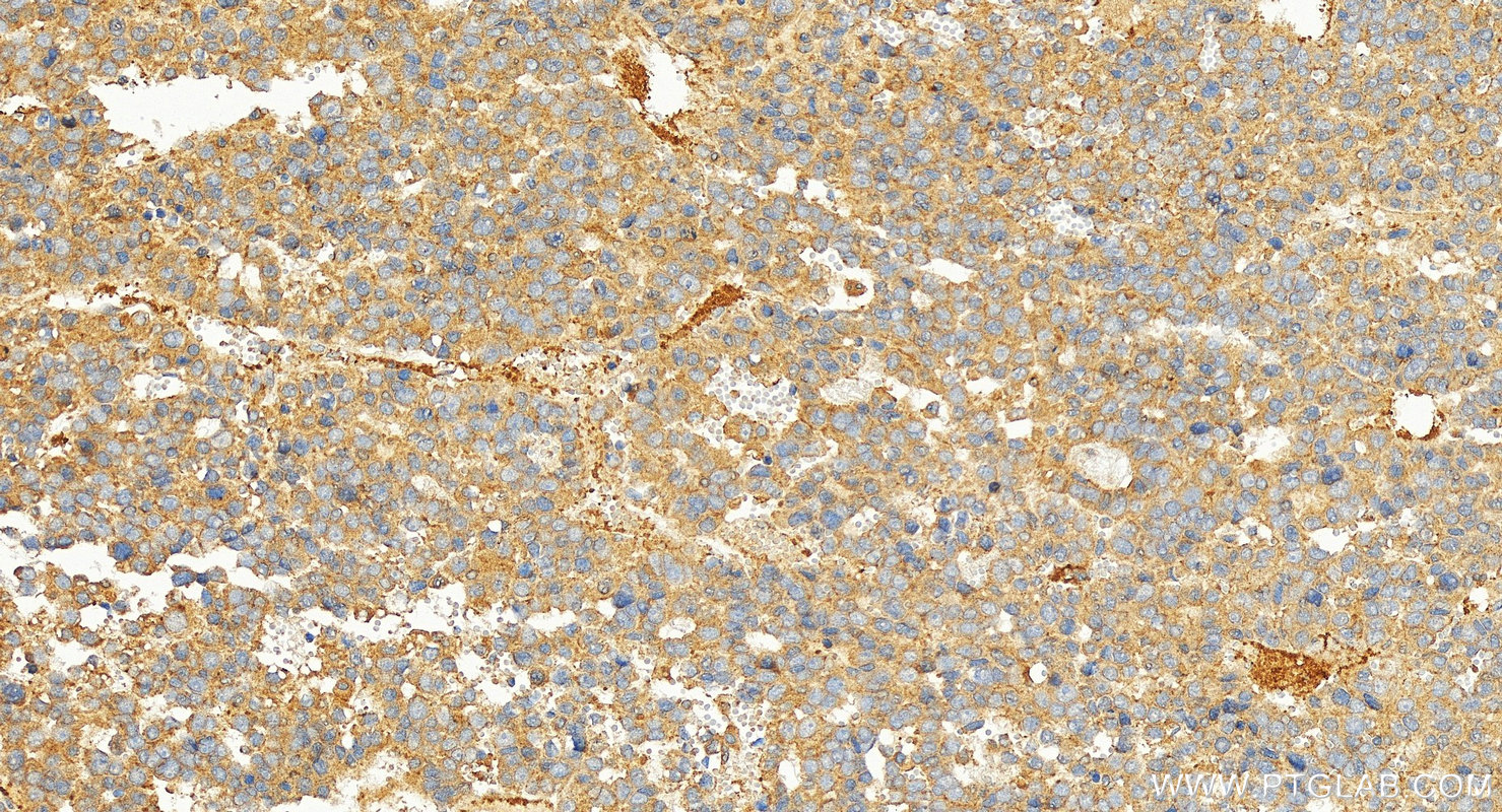 Immunohistochemical analysis of paraffin-embedded human hepatocellular cancer slide using 14492-1-AP (HBXIP antibody) at dilution of 1:400 (under 20x lens). Heat mediated antigen retrieval with Tris-EDTA buffer (pH 9.0). IHC staining of human hepatocellular cancer using 14492-1-AP