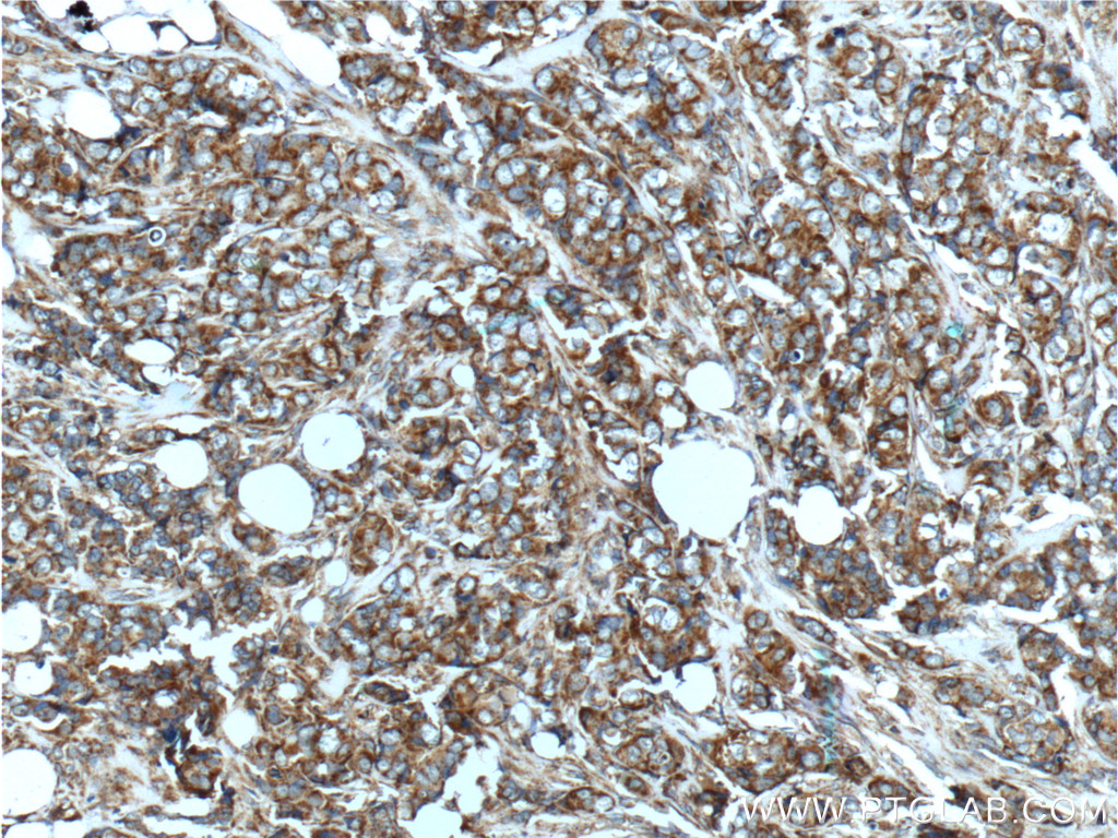 IHC staining of human breast cancer using 14492-1-AP