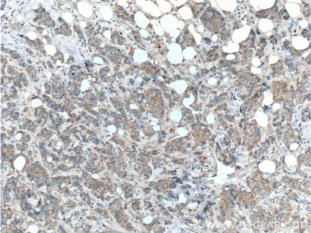 IHC staining of human breast cancer using 15118-1-AP