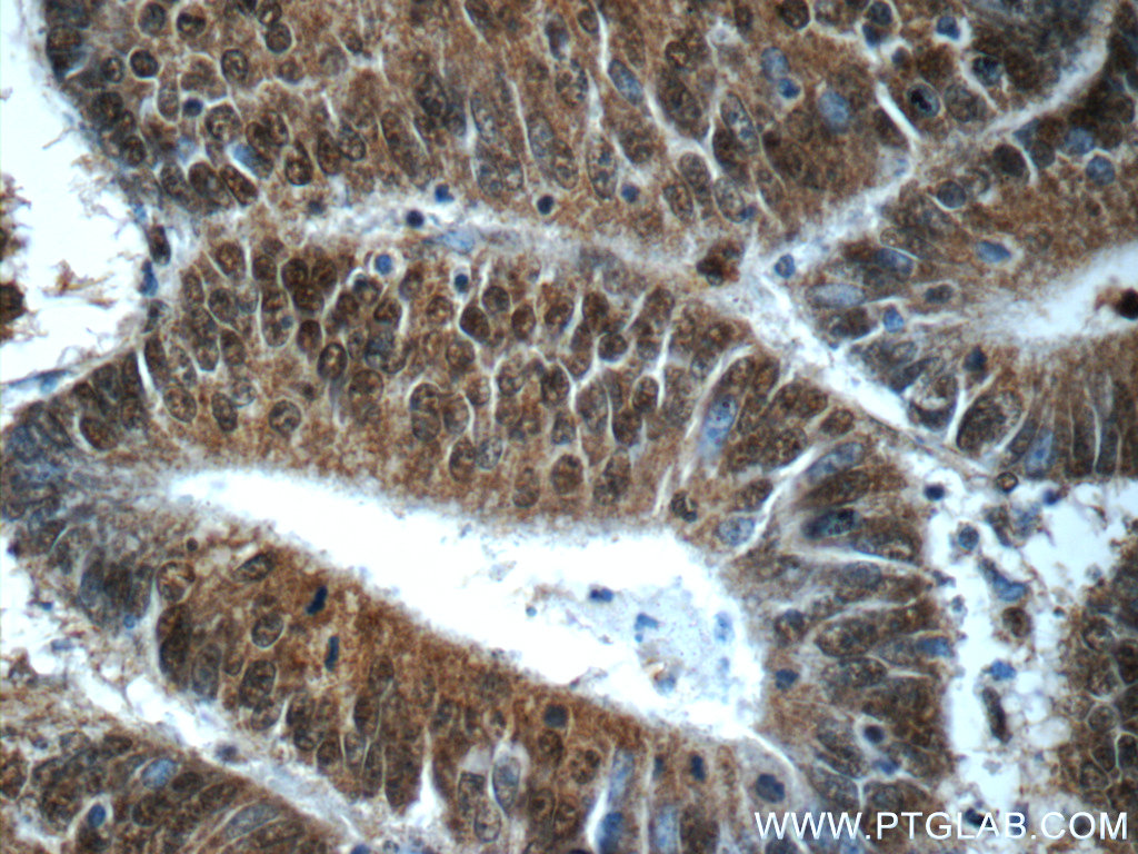 IHC staining of human colon cancer using 24913-1-AP