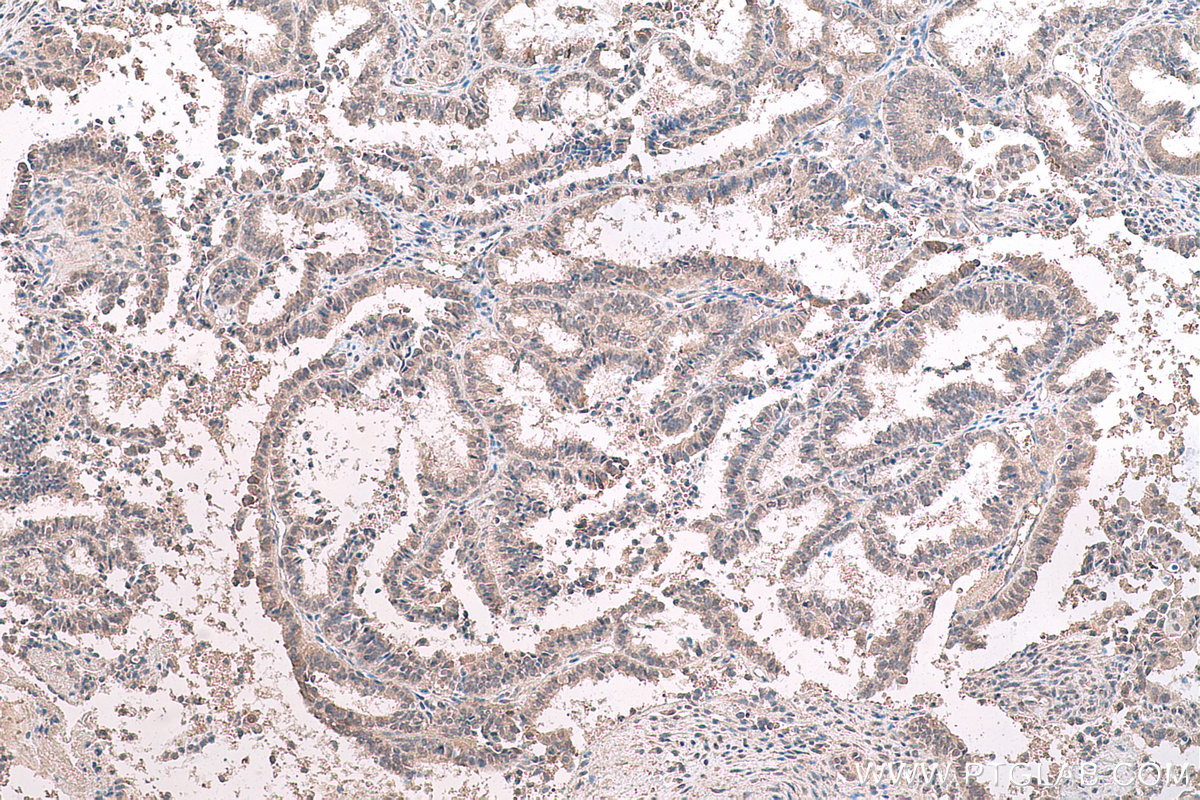 IHC staining of human ovary tumor using 67949-1-Ig (same clone as 67949-1-PBS)
