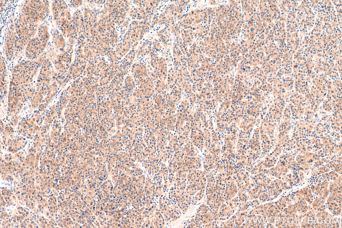 IHC staining of human liver cancer using 81211-1-RR
