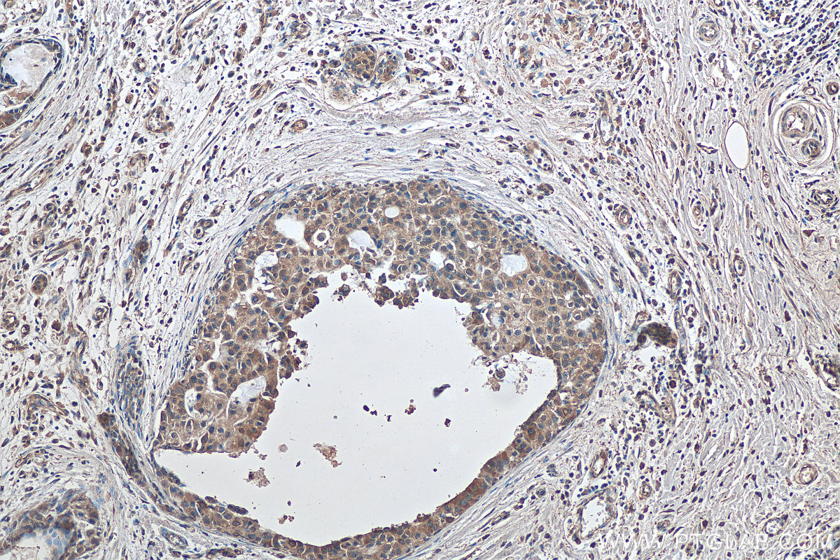 IHC staining of human breast cancer using 67250-1-Ig (same clone as 67250-1-PBS)