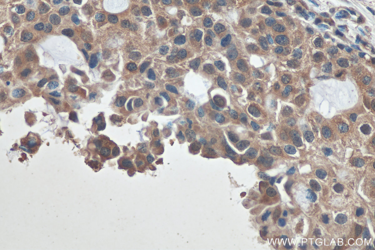 IHC staining of human breast cancer using 67250-1-Ig (same clone as 67250-1-PBS)