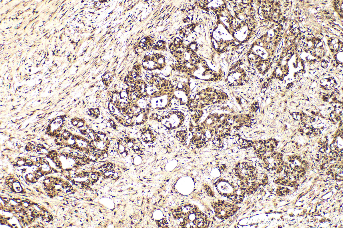 IHC staining of human colon cancer using 11344-1-AP IHC staining of human colon cancer using 11344-1-AP