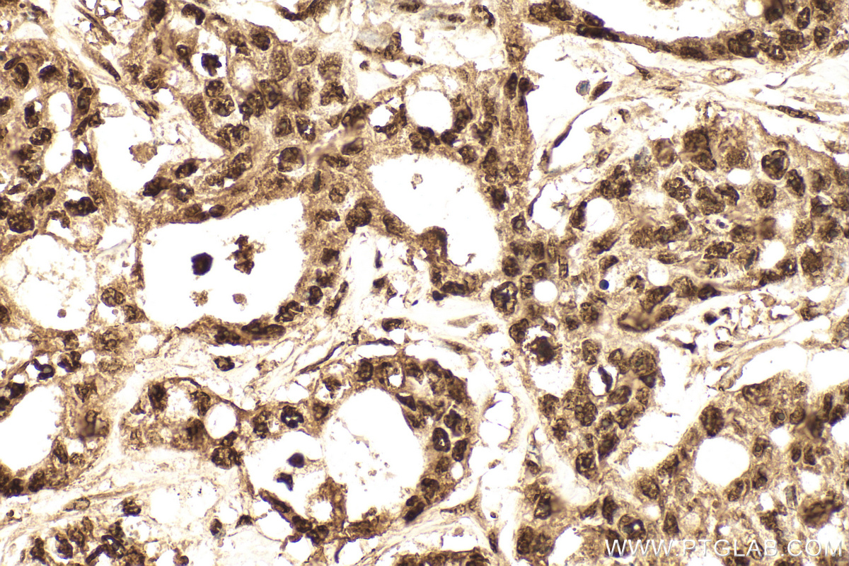 IHC staining of human colon cancer using 11344-1-AP IHC staining of human colon cancer using 11344-1-AP