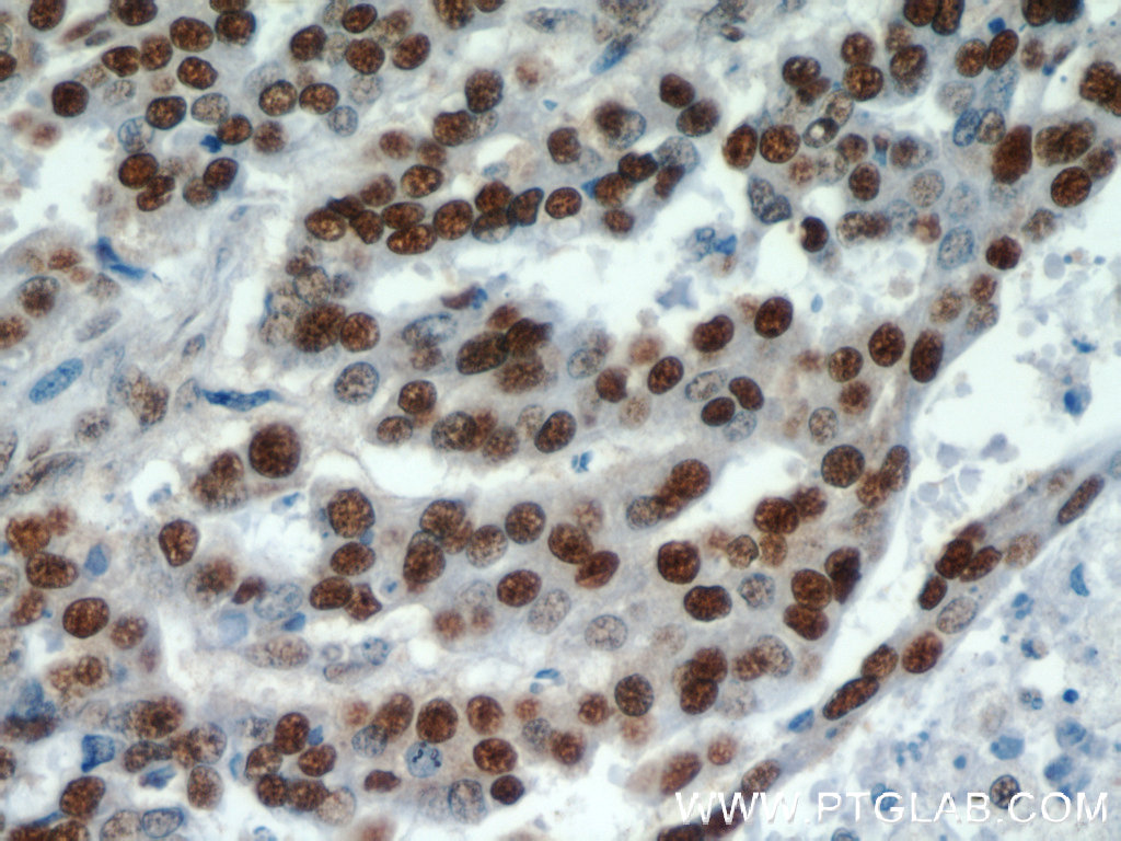 IHC staining of human ovary tumor using 11344-1-AP